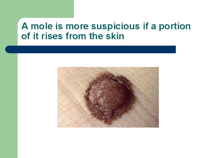 A mole is more suspicious if a portion of it rises from the skin