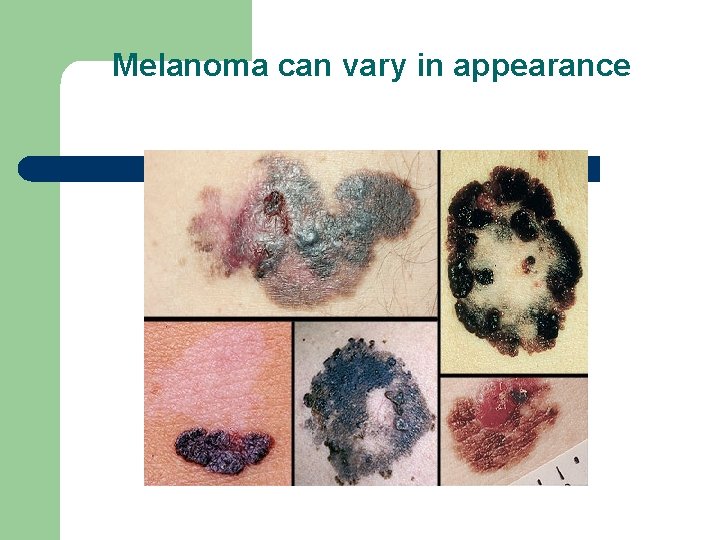Melanoma can vary in appearance 