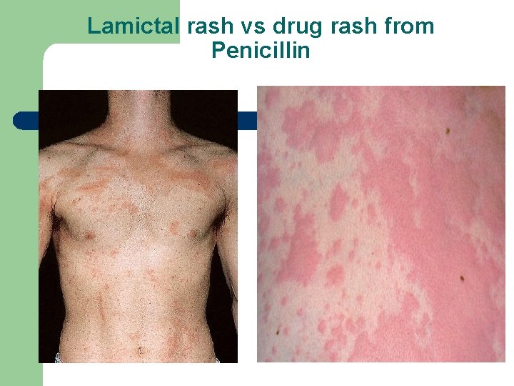 Lamictal rash vs drug rash from Penicillin 