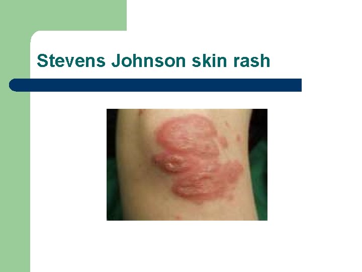 Stevens Johnson skin rash 