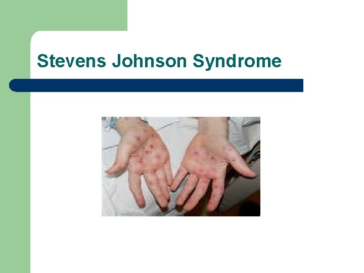 Stevens Johnson Syndrome 