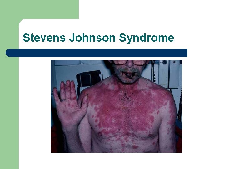 Stevens Johnson Syndrome 