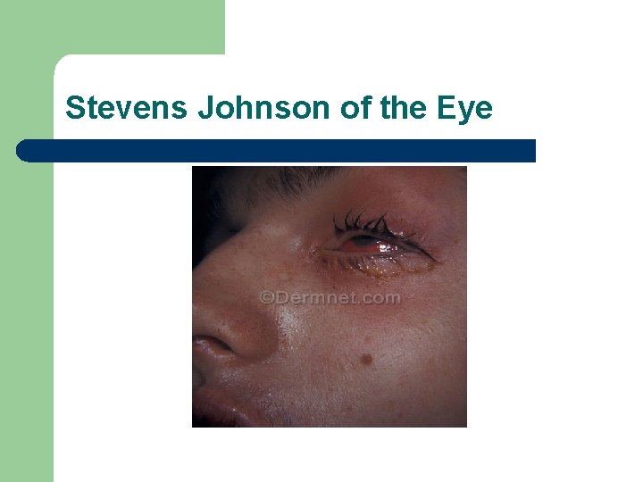 Stevens Johnson of the Eye 