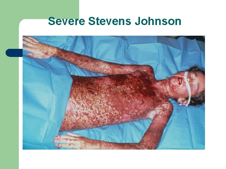 Severe Stevens Johnson 