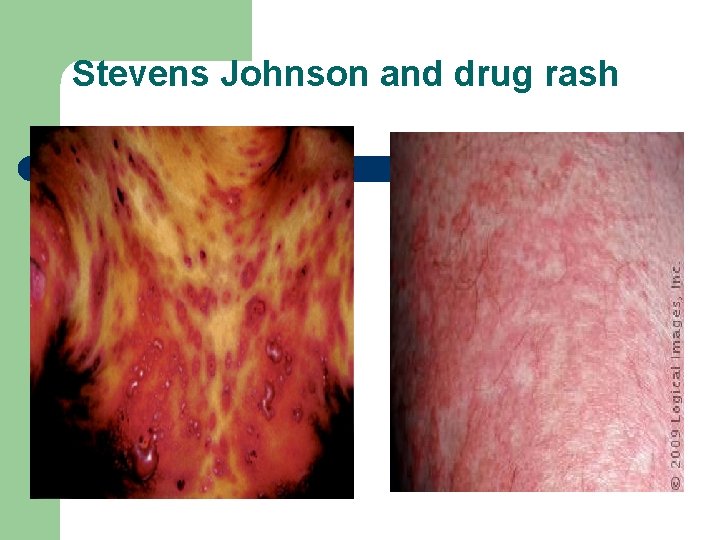 Stevens Johnson and drug rash 