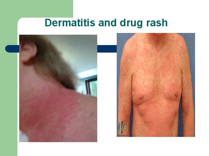 Dermatitis and drug rash 