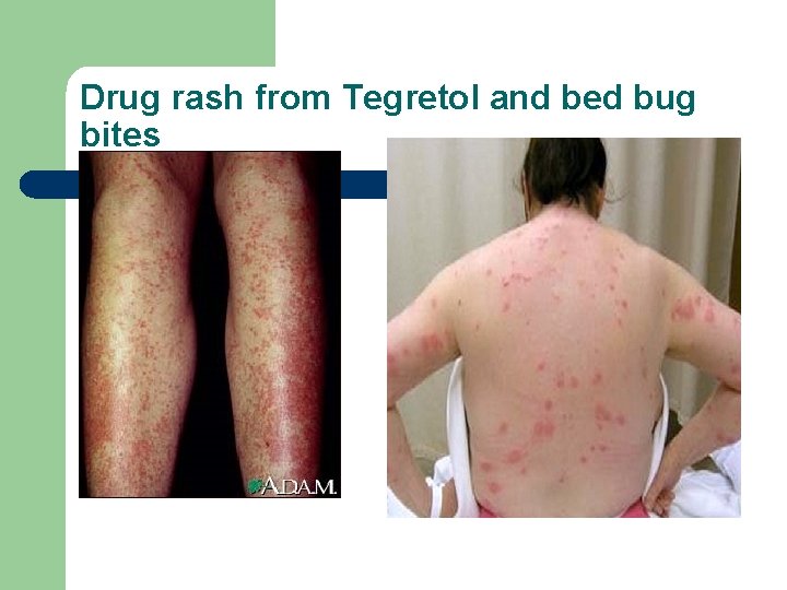 Drug rash from Tegretol and bed bug bites 