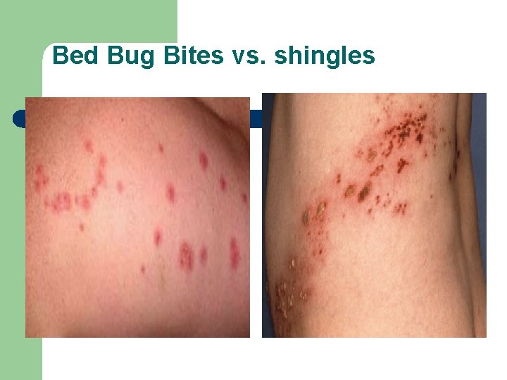 Bed Bug Bites vs. shingles 