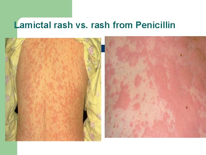 Lamictal rash vs. rash from Penicillin 
