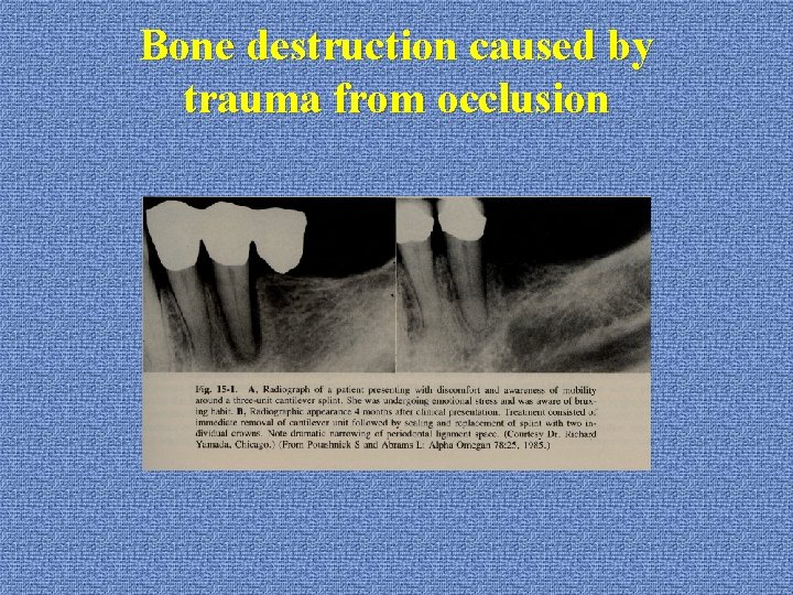 Bone destruction caused by trauma from occlusion 