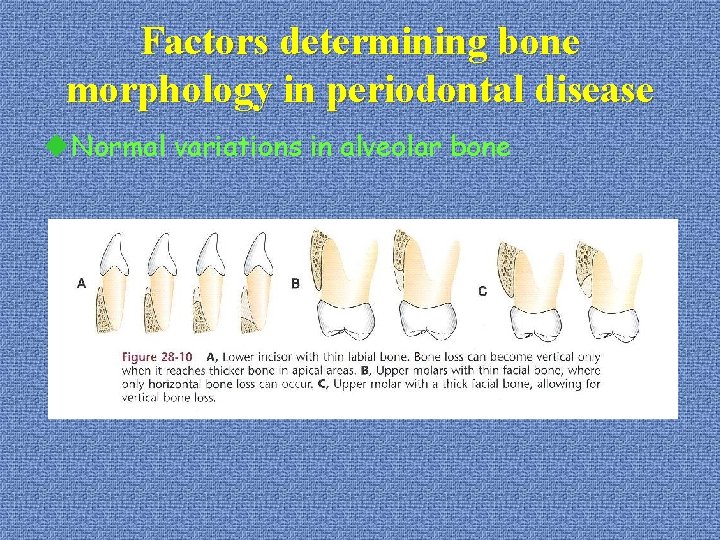 Factors determining bone morphology in periodontal disease u. Normal variations in alveolar bone 