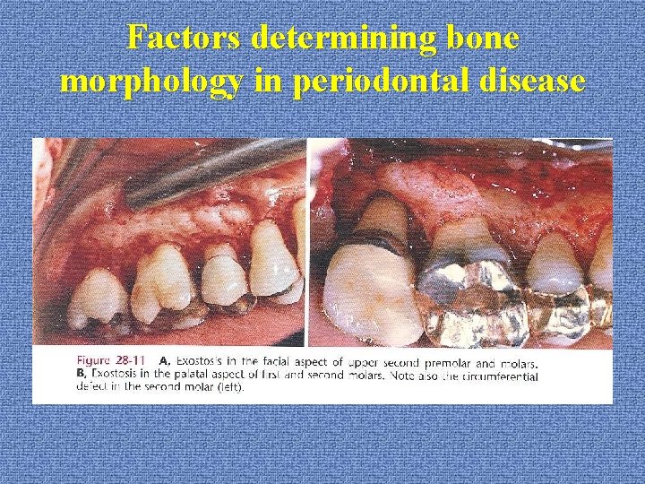 Factors determining bone morphology in periodontal disease 