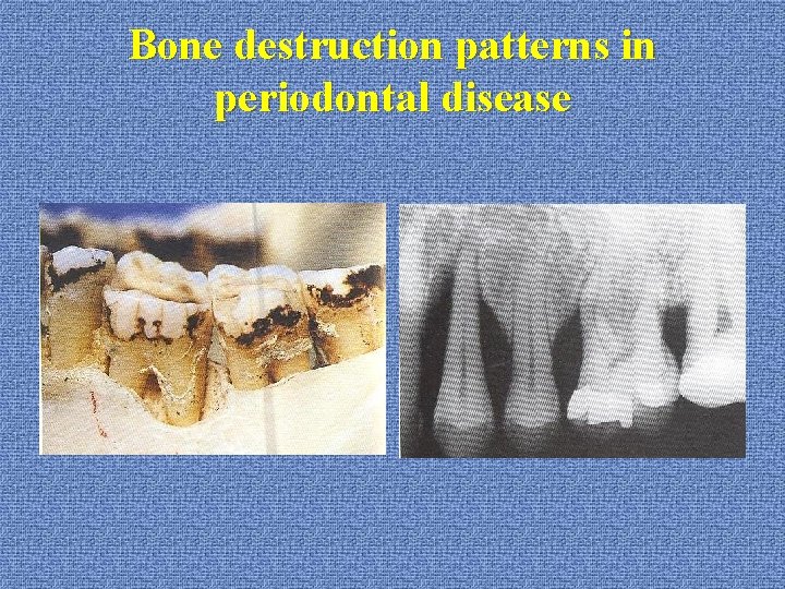 Bone destruction patterns in periodontal disease 