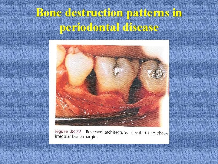 Bone destruction patterns in periodontal disease 