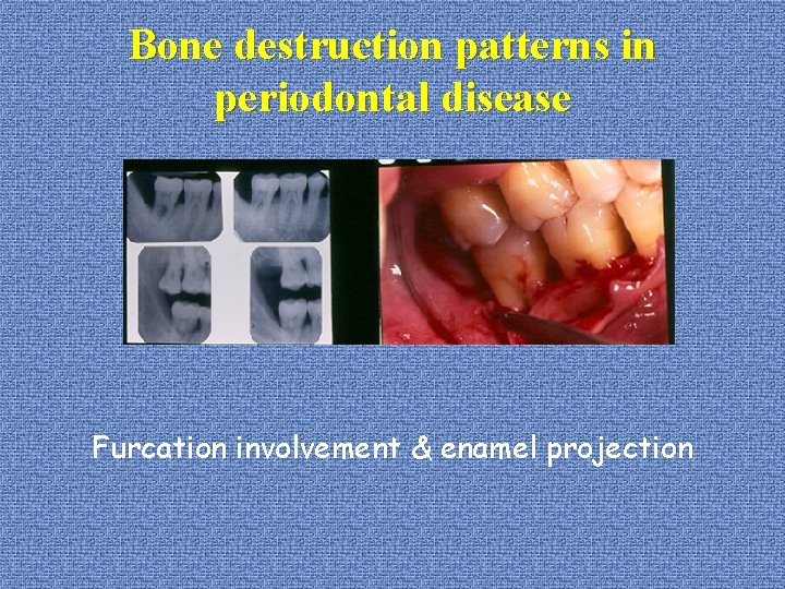 Bone destruction patterns in periodontal disease Furcation involvement & enamel projection 