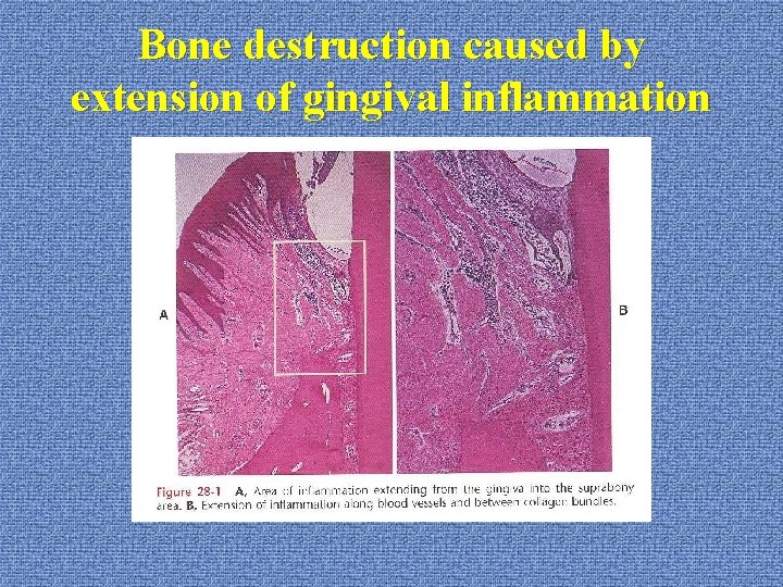 Bone destruction caused by extension of gingival inflammation 