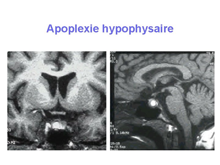 Apoplexie hypophysaire Apoplexie hypophysaire