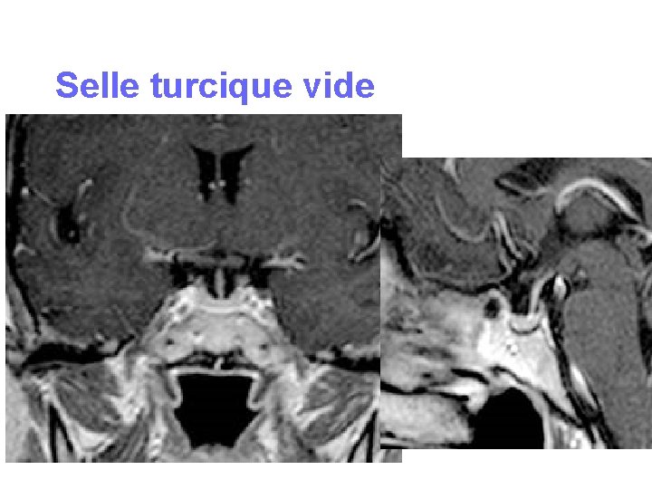 Selle turcique vide Selle turcique vide