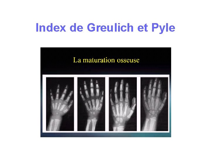 Index de Greulich et Pyle Index de Greulich et Pyle