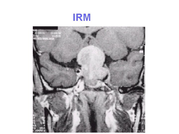 IRM IRM