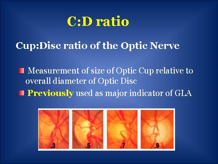 C: D ratio Cup: Disc ratio of the Optic Nerve Measurement of size of