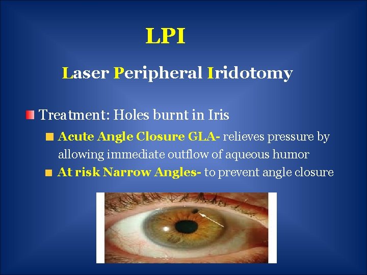 LPI Laser Peripheral Iridotomy Treatment: Holes burnt in Iris Acute Angle Closure GLA- relieves