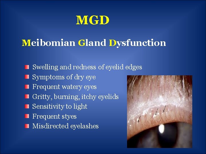 MGD Meibomian Gland Dysfunction Swelling and redness of eyelid edges Symptoms of dry eye