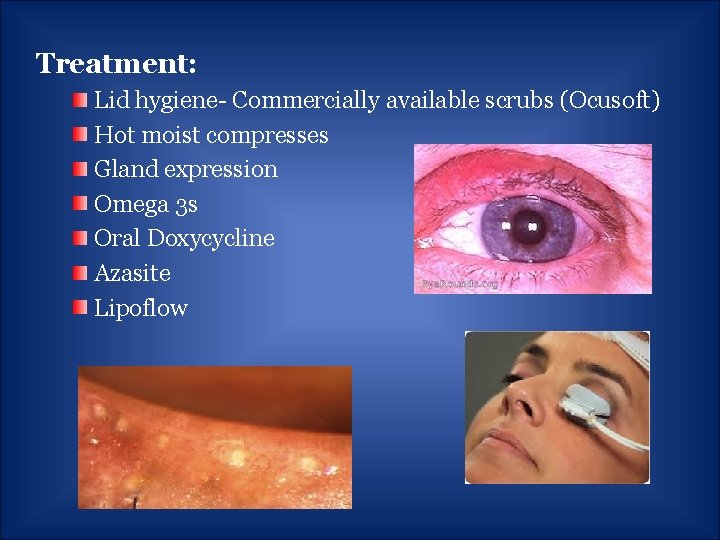 Treatment: Lid hygiene- Commercially available scrubs (Ocusoft) Hot moist compresses Gland expression Omega 3