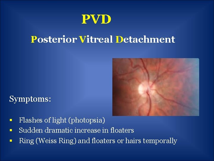 PVD Posterior Vitreal Detachment Symptoms: § Flashes of light (photopsia) § Sudden dramatic increase