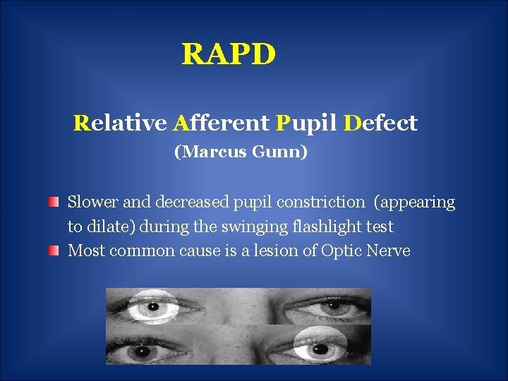 RAPD Relative Afferent Pupil Defect (Marcus Gunn) Slower and decreased pupil constriction (appearing to