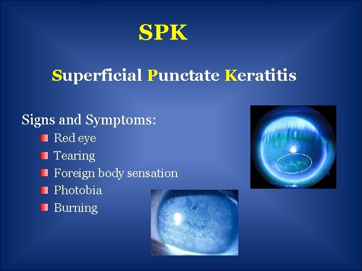 SPK Superficial Punctate Keratitis Signs and Symptoms: Red eye Tearing Foreign body sensation Photobia