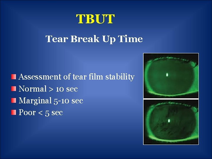 TBUT Tear Break Up Time Assessment of tear film stability Normal > 10 sec