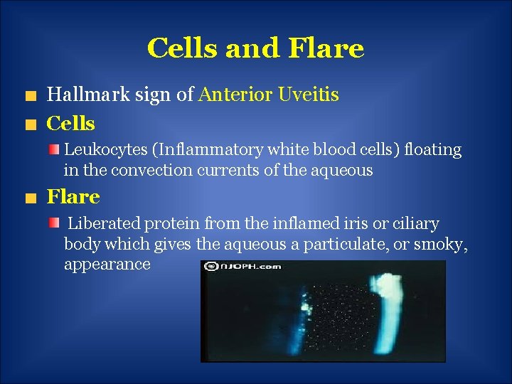 Cells and Flare Hallmark sign of Anterior Uveitis Cells Leukocytes (Inflammatory white blood cells)