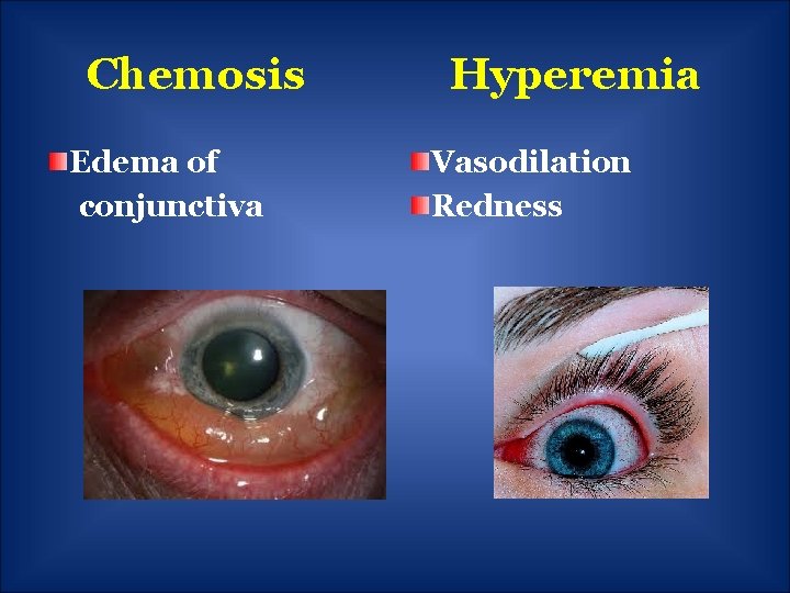 Chemosis Edema of conjunctiva Hyperemia Vasodilation Redness 