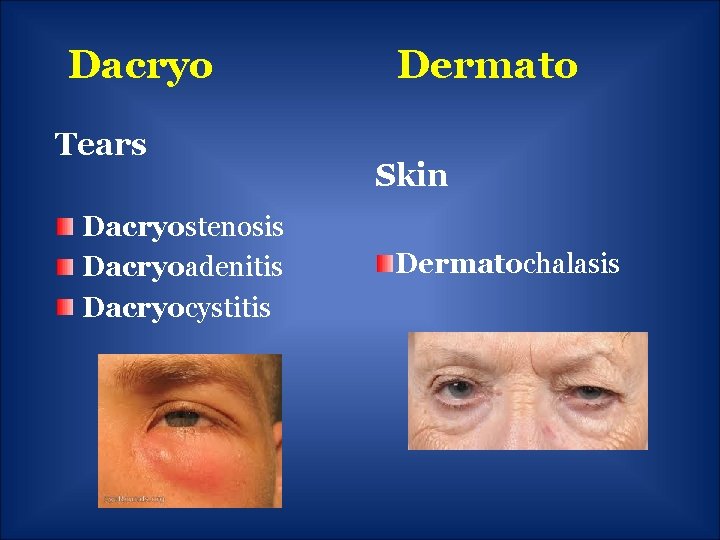 Dacryo Tears Dacryostenosis Dacryoadenitis Dacryocystitis Dermato Skin Dermatochalasis 