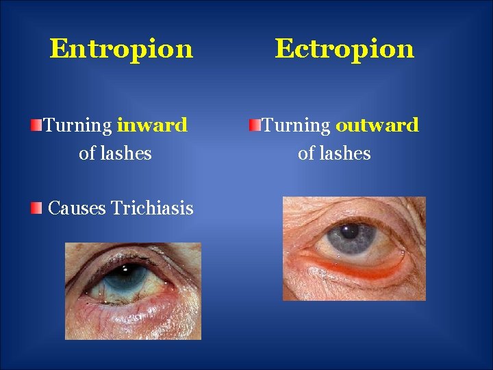 Entropion Ectropion Turning inward of lashes Turning outward of lashes Causes Trichiasis 
