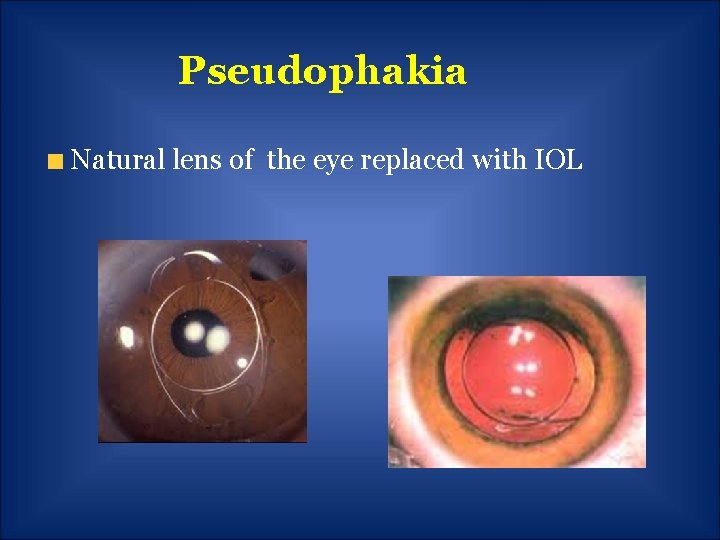 Pseudophakia Natural lens of the eye replaced with IOL 