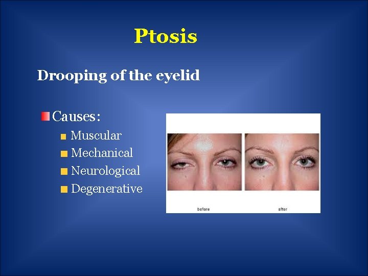 Ptosis Drooping of the eyelid Causes: Muscular Mechanical Neurological Degenerative 