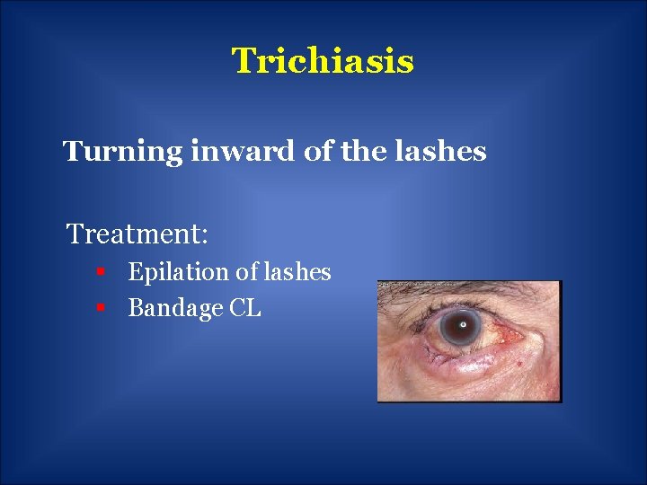 Trichiasis Turning inward of the lashes Treatment: § Epilation of lashes § Bandage CL