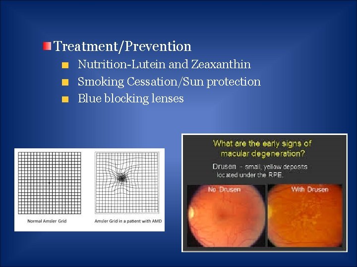 Treatment/Prevention Nutrition-Lutein and Zeaxanthin Smoking Cessation/Sun protection Blue blocking lenses 