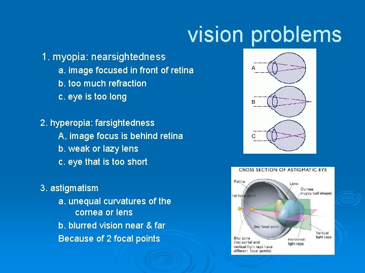 vision problems 1. myopia: nearsightedness a. image focused in front of retina b. too