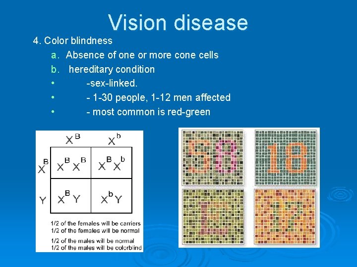 Vision disease 4. Color blindness a. Absence of one or more cone cells b.
