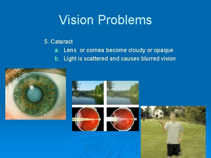 Vision Problems 5. Cataract a. Lens or cornea become cloudy or opaque b. Light