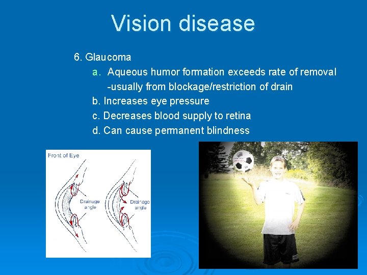 Vision disease 6. Glaucoma a. Aqueous humor formation exceeds rate of removal -usually from