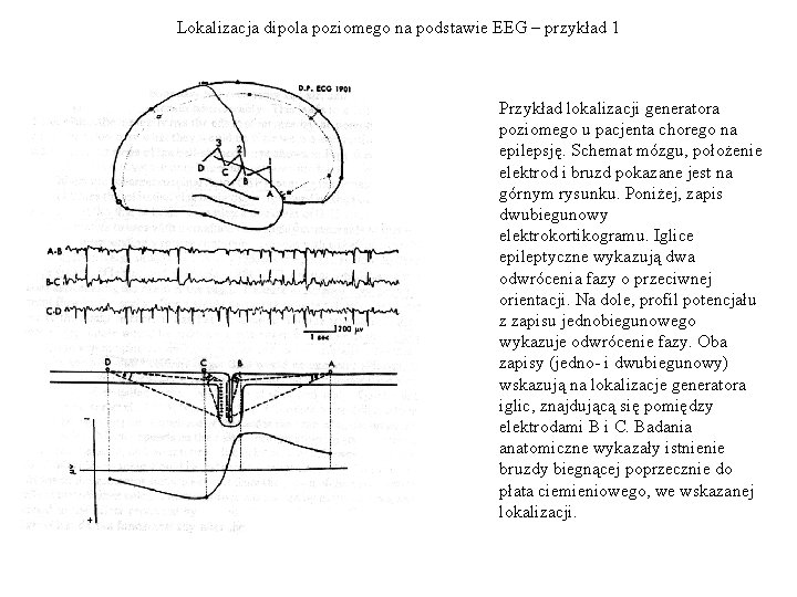 Lokalizacja dipola poziomego na podstawie EEG – przykład 1 Przykład lokalizacji generatora poziomego u