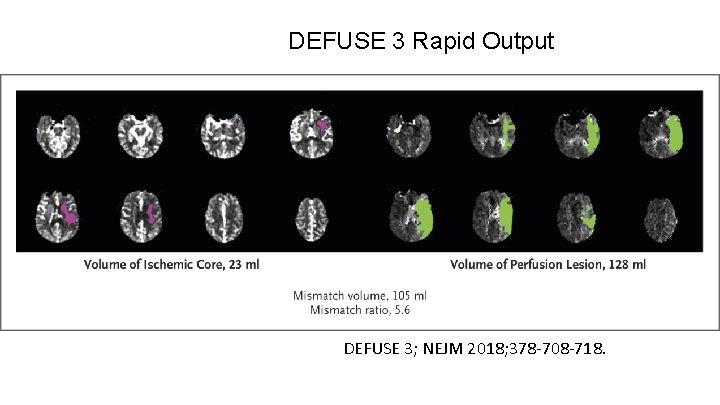 DEFUSE 3 Rapid Output DEFUSE 3; NEJM 2018; 378 -708 -718. 