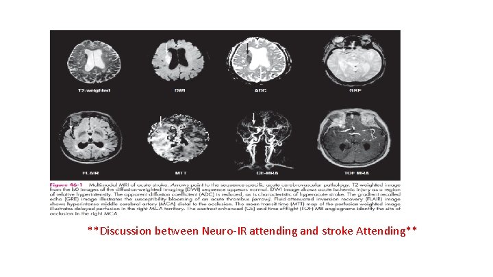 **Discussion between Neuro-IR attending and stroke Attending** 