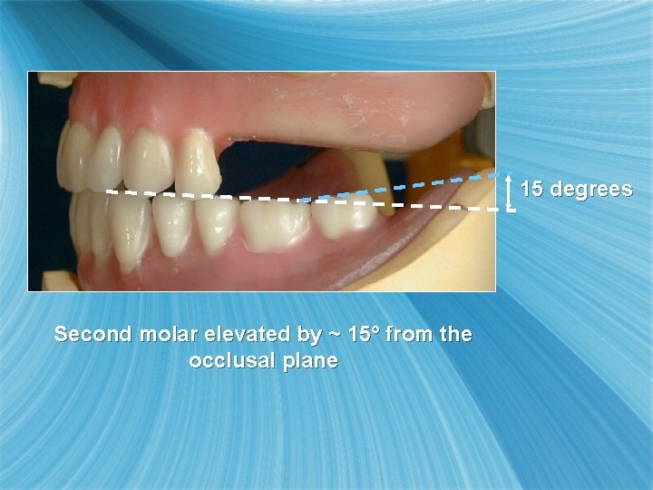 15 degrees Second molar elevated by ~ 15° from the occlusal plane 