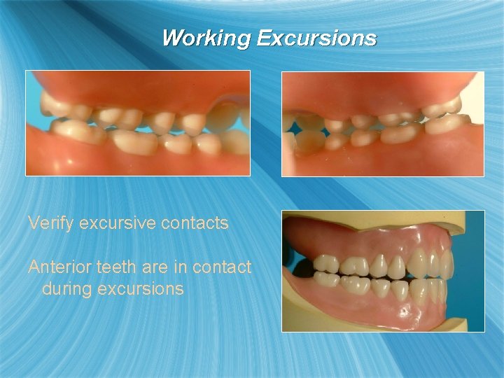 Working Excursions Verify excursive contacts Anterior teeth are in contact during excursions 