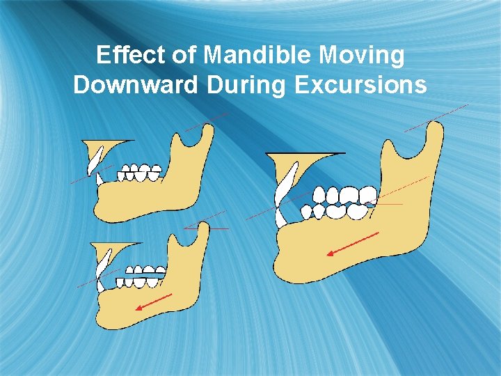 Effect of Mandible Moving Downward During Excursions 